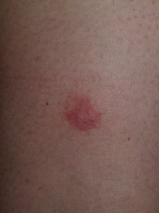 에스로반 연고 5